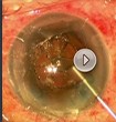 Egy phacomorph glaucomás szem  szürkehályog műtétjének manuális része